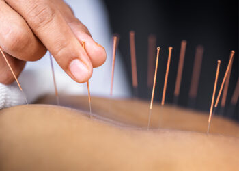 Stiati ca acupunctura este o forma foarte veche de vindecare, care dateaza din pre-istoric ?