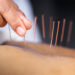 Stiati ca acupunctura este o forma foarte veche de vindecare, care dateaza din pre-istoric ?
