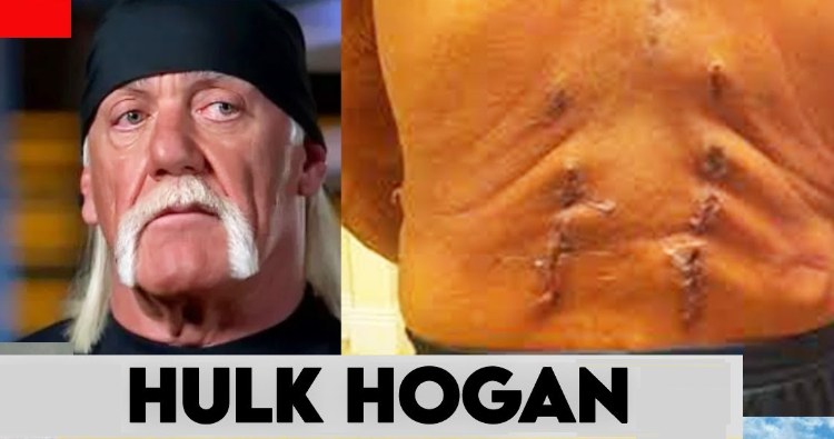 Hulk Hogan, probleme grave de sănătate! A rămas paralizat!