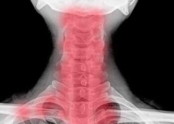 Ce este spondiloza cervicală? Ce tratamente naturiste ajuă la ameliorarea ei?