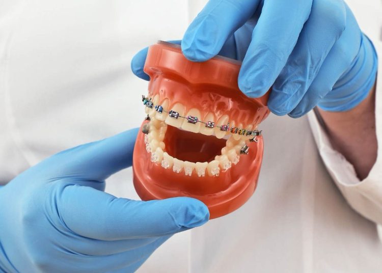 5 Beneficii ale Aparatului Dentar asupra Sănătății Orale