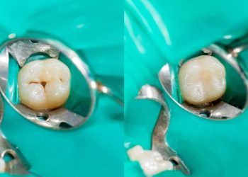 De la ce varsta este necesara ingrijirea orala?